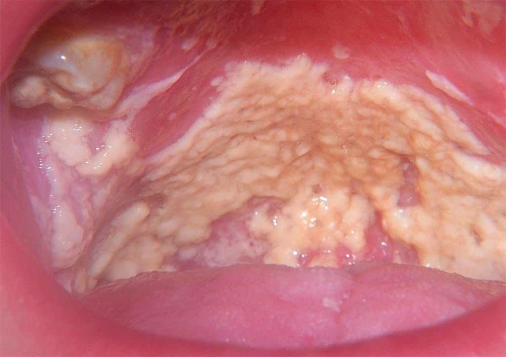 Симптомы грибка во рту