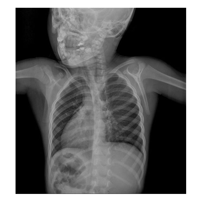 Грудная клетка ребенка 2 года. Рентген грудной клетки 6лет. Детский рентген грудной клетки. Рентген ОГК У новорожденных.