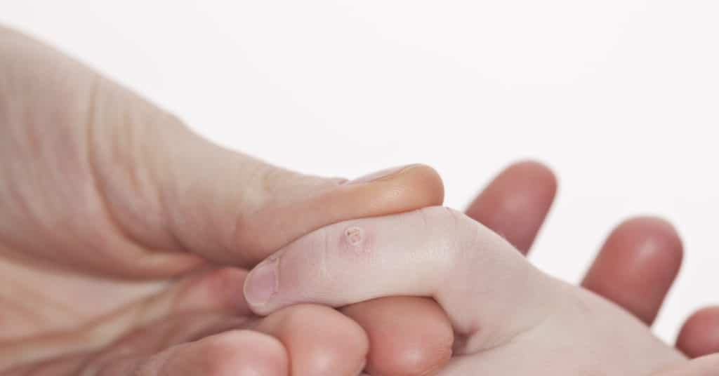 Бородавка на пальце у ребенка