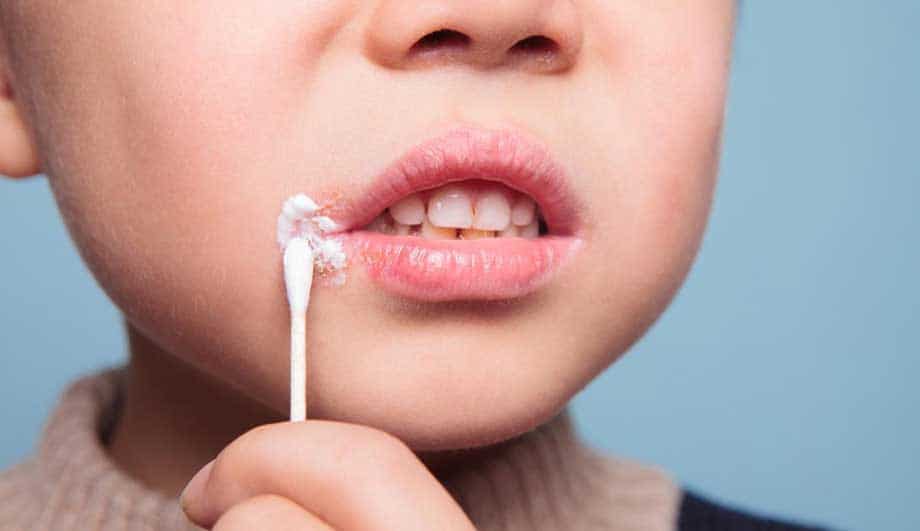 Лечение грибка на губах у детей