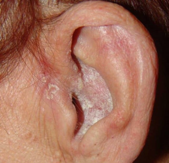 псориаз внутри уха
