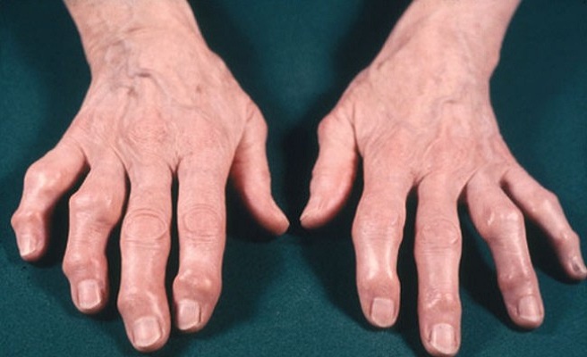 Деформация пальцев руки