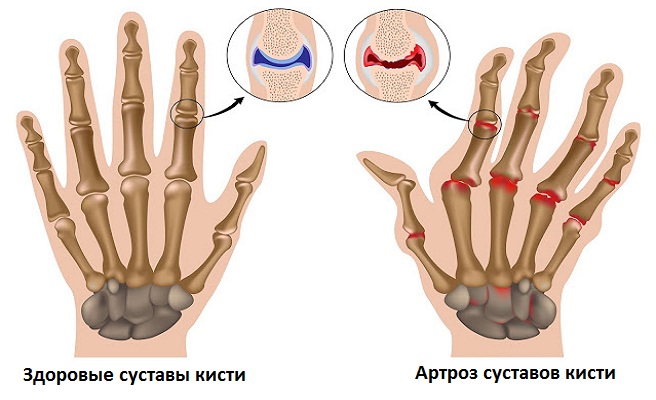 Повреждения суставов рук