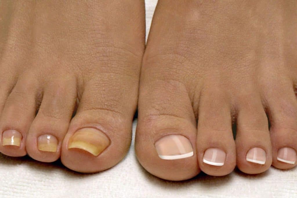 Лечение грибка ногтей керосином