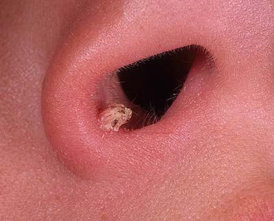 Папиллома в полости носа