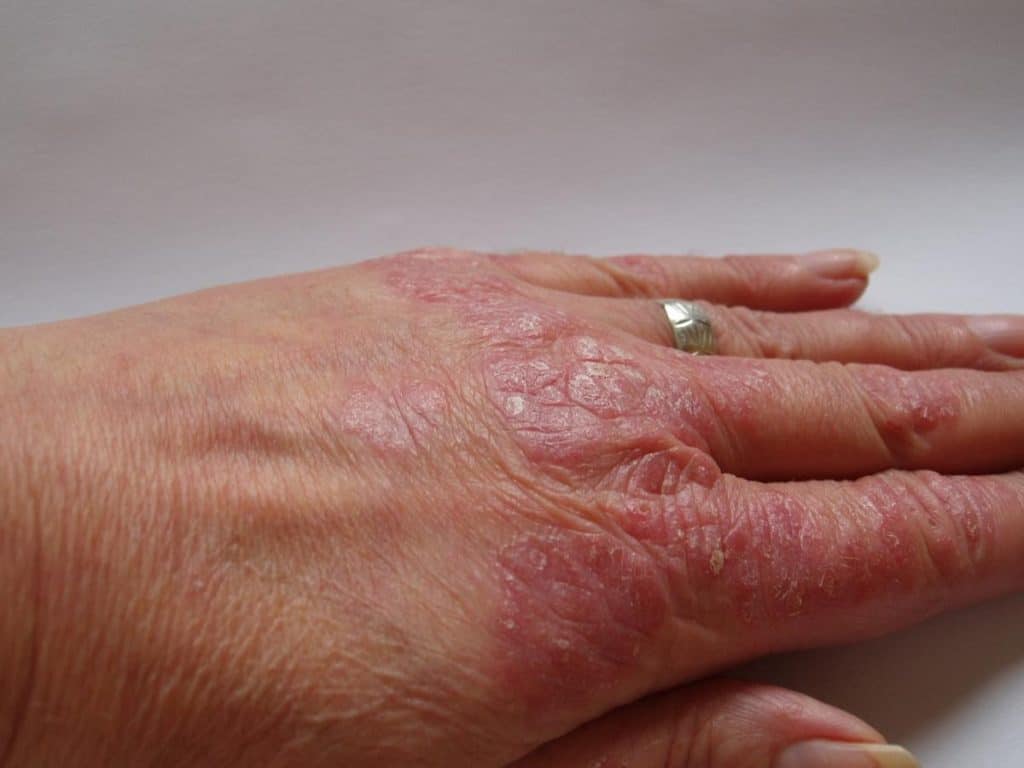 симптомы псориаза на руках