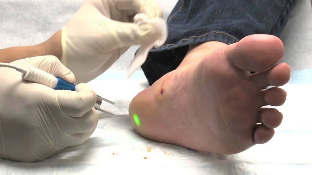 Лазерное удаление папилломы на ноге