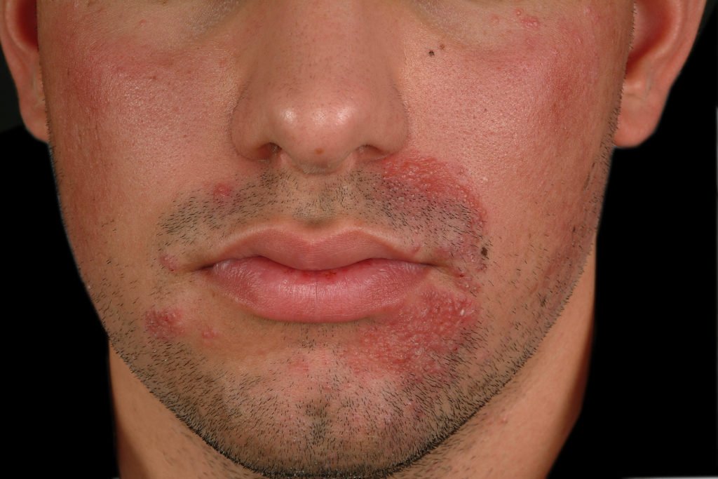Применение Орунгала при дерматофитии на лице