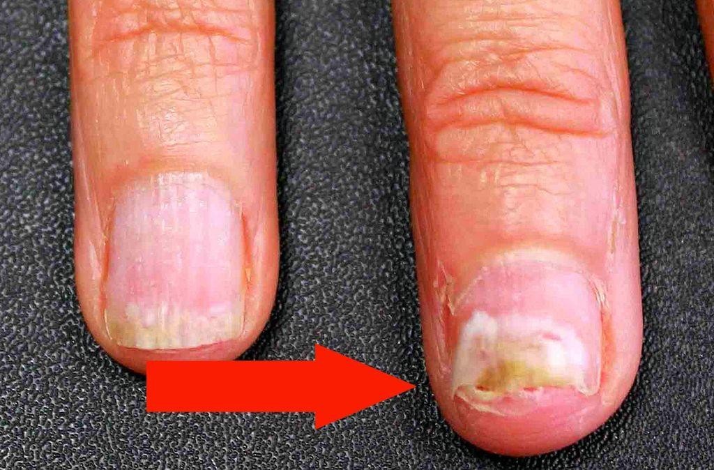 Первые признаки псориаза ногтей