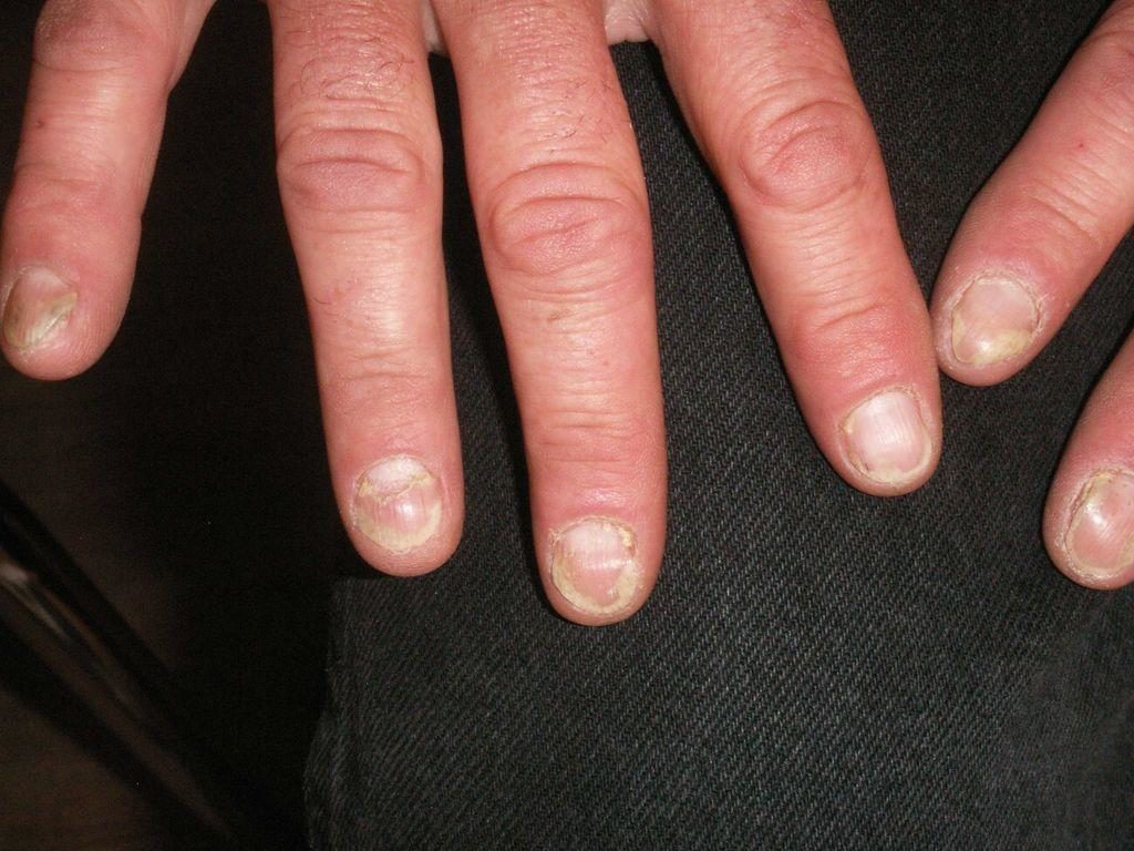 Поражение ногтей при псориатическом артрите