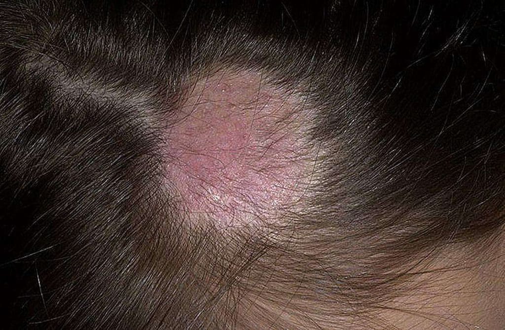 Микроспория кожи головы