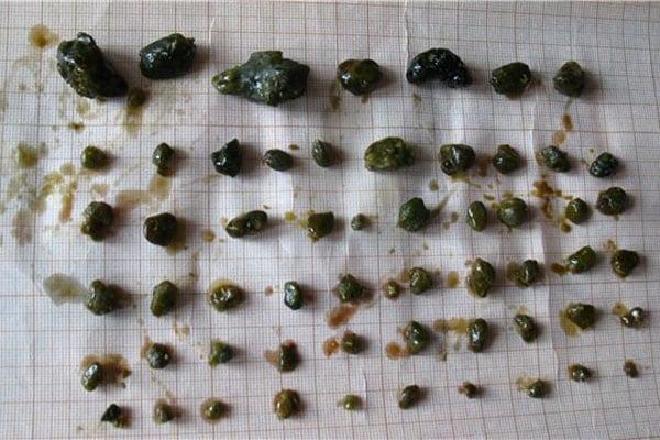 Какого размера камень может выйти сам. Микролиты в желчном пузыре. Билирубиновые (пигментные) камни. Зеленые билирубиновые камни.